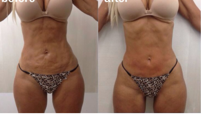 Фотона Боди 4